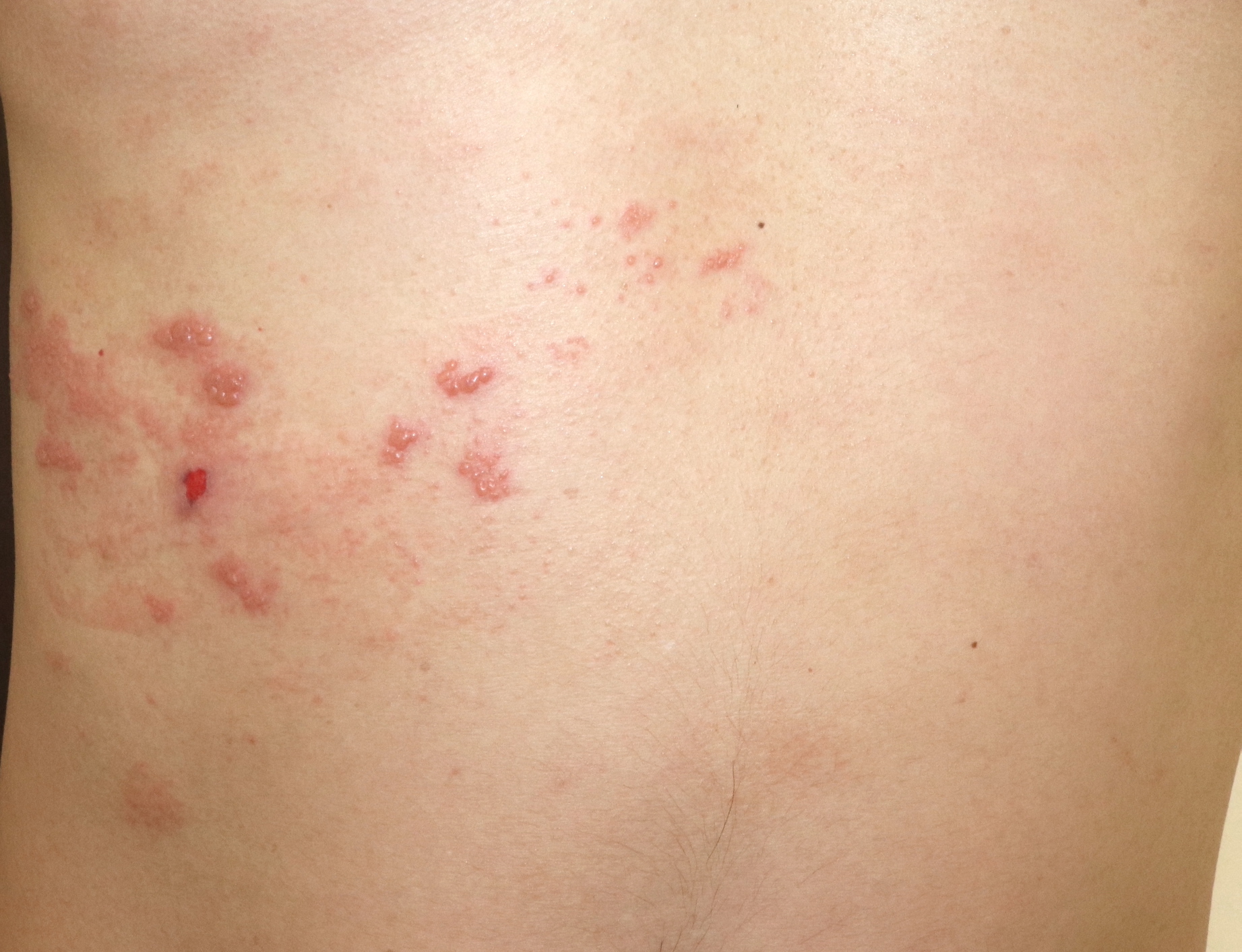背部の湿疹です。（湿潤療法） - 粉瘤（アテローム） | こおりたひろ整形形成外科クリニック - 痛みの少ない粉瘤治療で多数の実績｜大阪｜